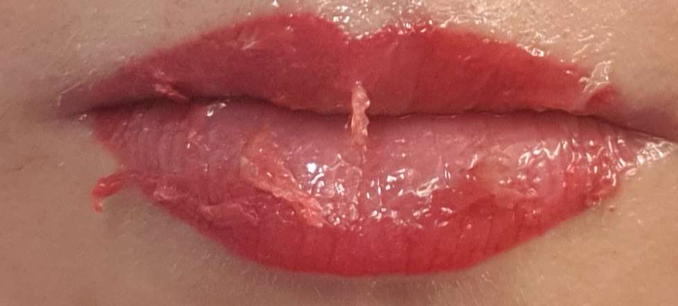 photo trois jours après lèvres
